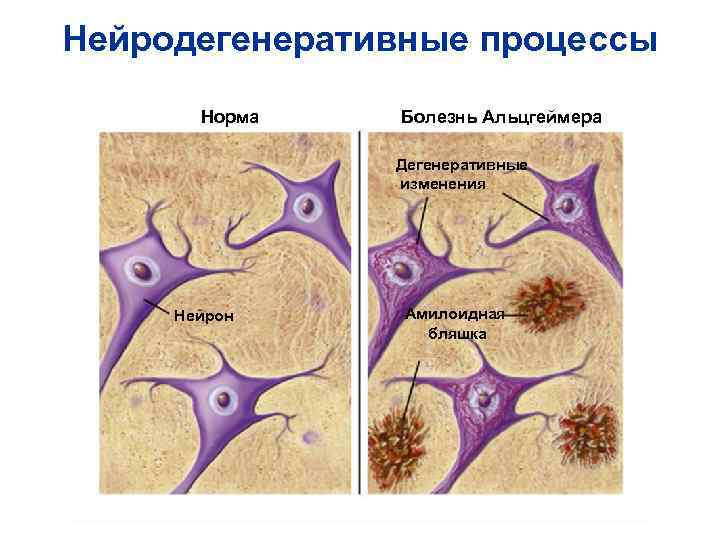 Нейродегенеративные процессы Норма Болезнь Альцгеймера Дегенеративные Нейродегенеративные процессы Норма Болезнь Альцгеймера Дегенеративные