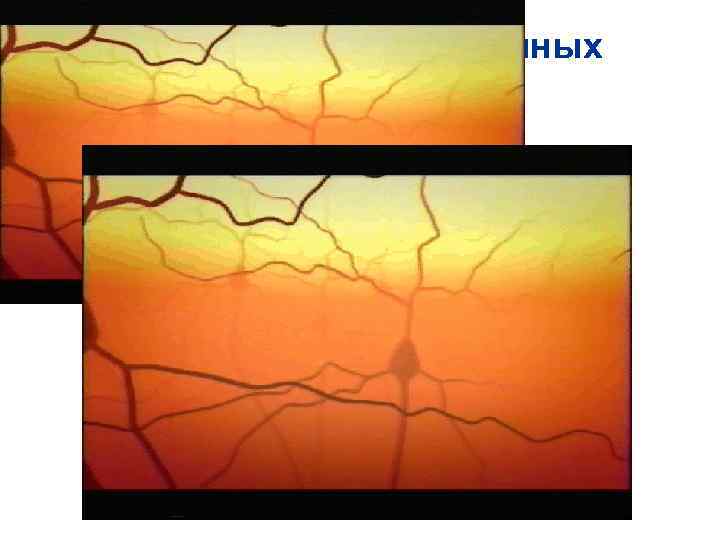 Нарушение межнейронных взаимодействий Нарушение межнейронных взаимодействий