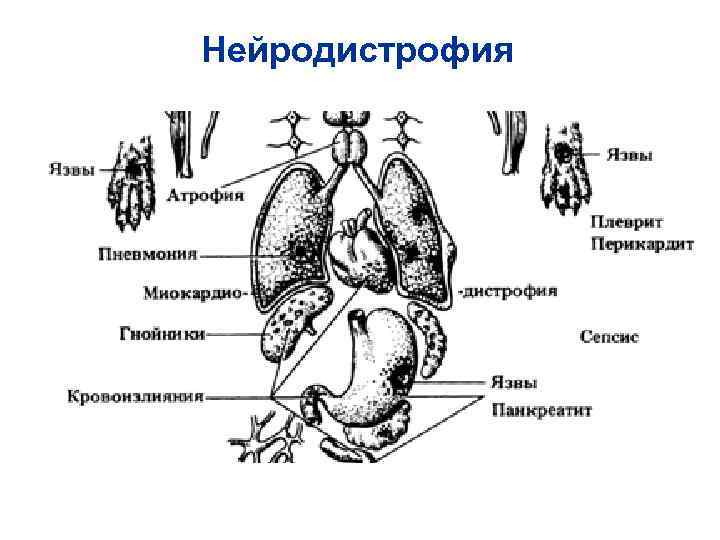 Нейродистрофия Нейродистрофия