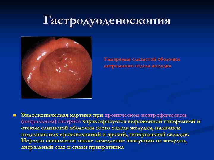   Гастродуоденоскопия       Гиперемия слизистой оболочки  