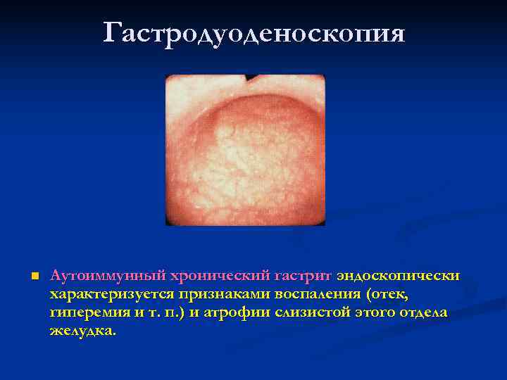    Гастродуоденоскопия n  Аутоиммунный хронический гастрит эндоскопически характеризуется признаками воспаления (отек,
