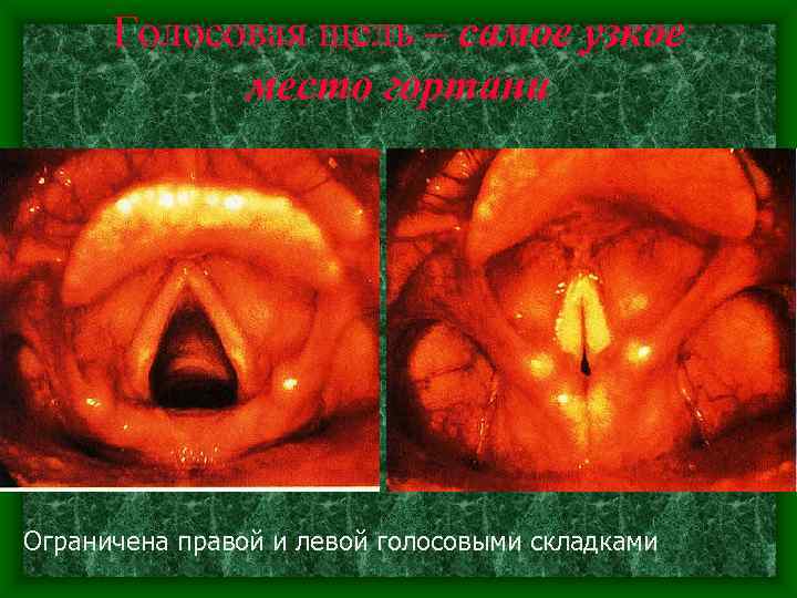  Голосовая щель – самое узкое   место гортани Ограничена правой и левой