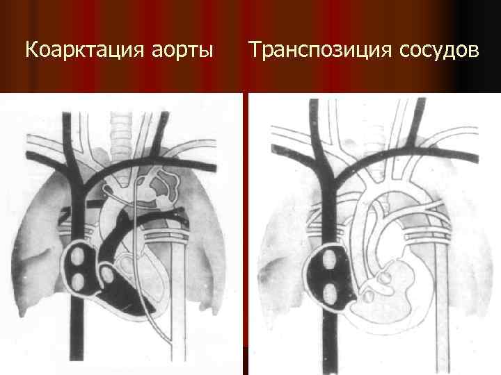 Дуга аорты расширена