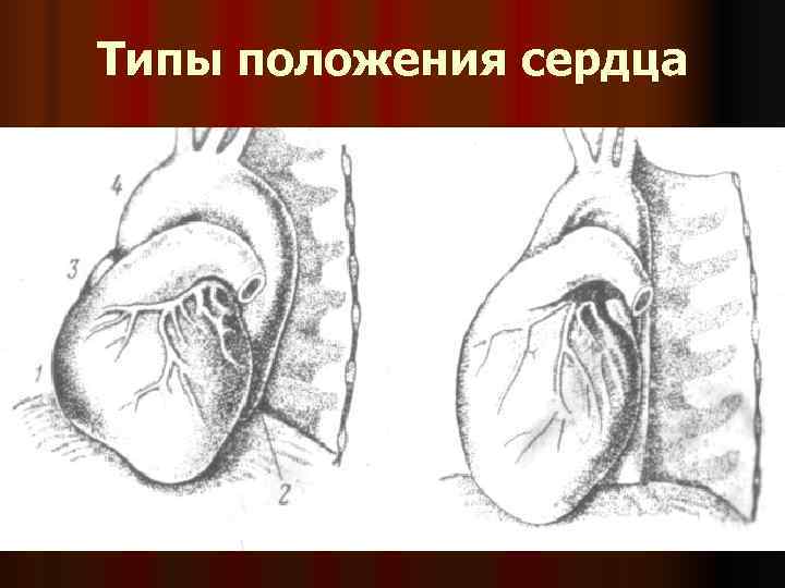 Типы положения сердца 