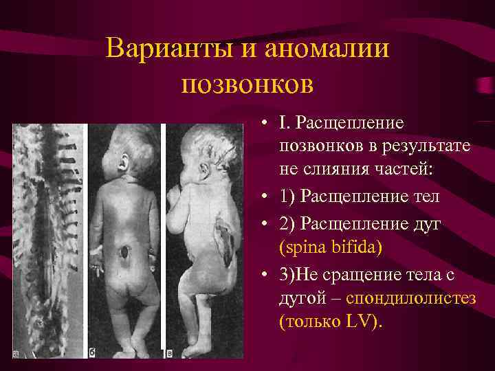 Варианты и аномалии позвонков • I. Расщепление позвонков в результате Варианты и аномалии позвонков • I. Расщепление позвонков в результате