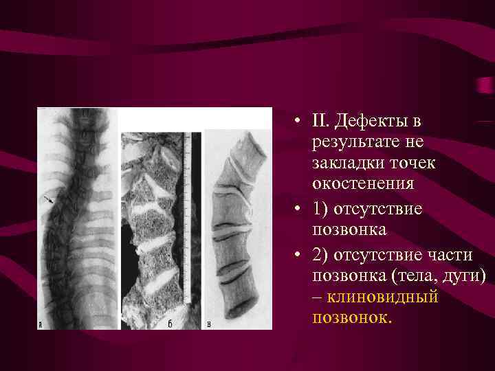 • II. Дефекты в результате не закладки точек окостенения • • II. Дефекты в результате не закладки точек окостенения •