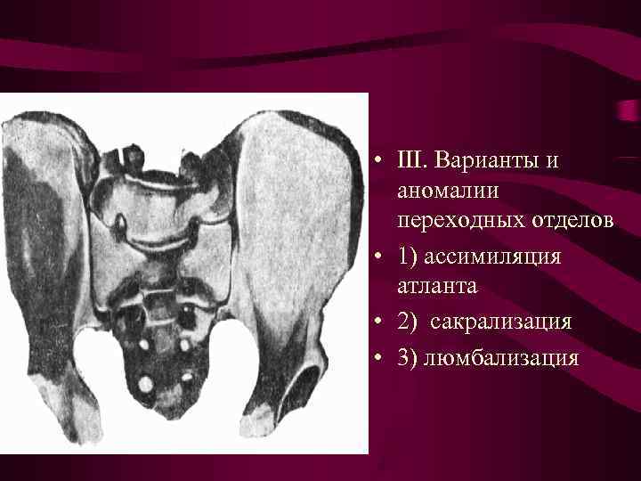 • III. Варианты и аномалии переходных отделов • 1) ассимиляция • III. Варианты и аномалии переходных отделов • 1) ассимиляция