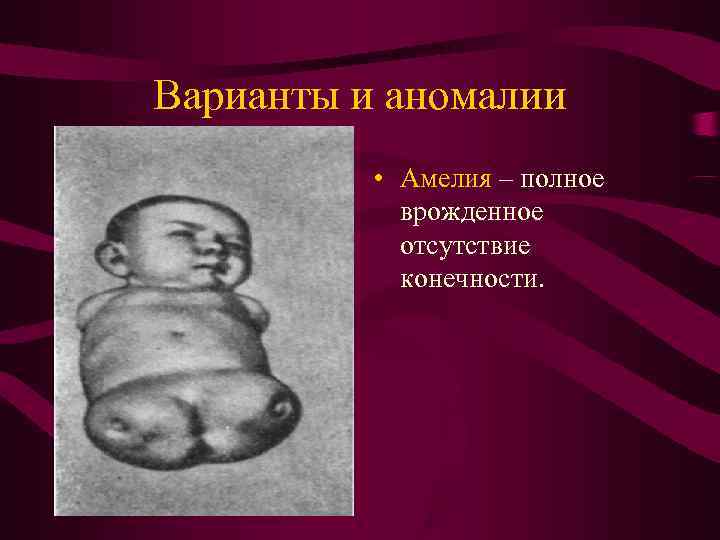 Варианты и аномалии • Амелия – полное врожденное отсутствие Варианты и аномалии • Амелия – полное врожденное отсутствие