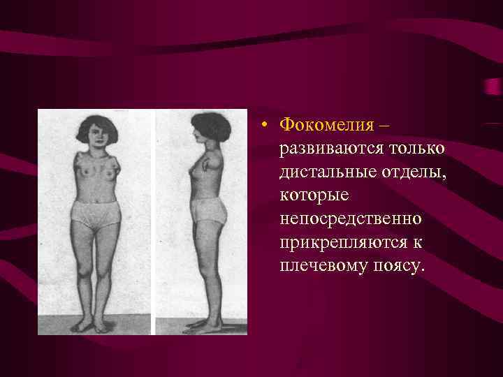 • Фокомелия – развиваются только дистальные отделы, которые непосредственно • Фокомелия – развиваются только дистальные отделы, которые непосредственно