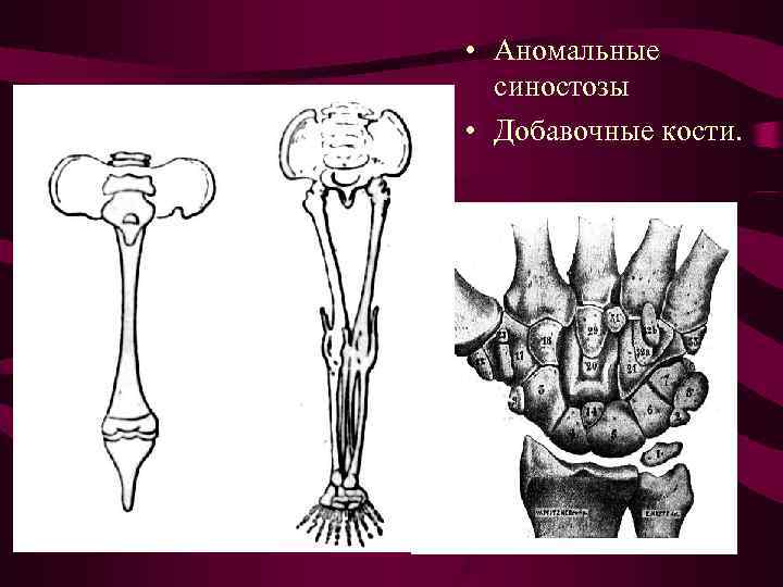 • Аномальные синостозы • Добавочные кости. • Аномальные синостозы • Добавочные кости.