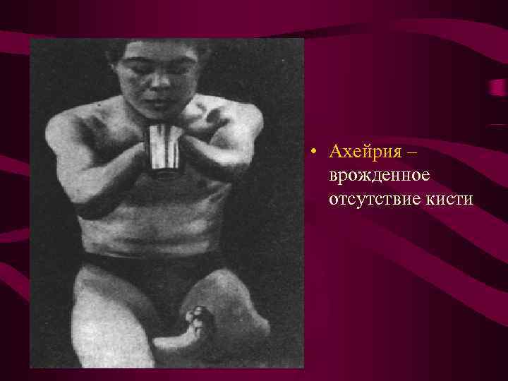 • Ахейрия – врожденное отсутствие кисти • Ахейрия – врожденное отсутствие кисти