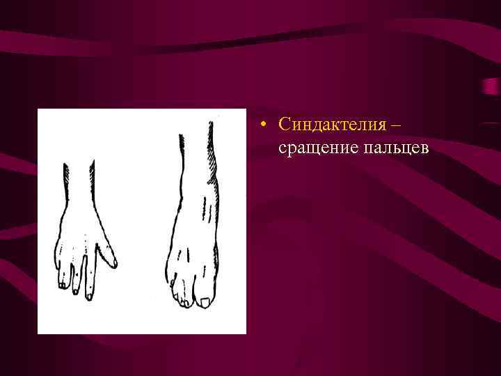 • Синдактелия – сращение пальцев • Синдактелия – сращение пальцев
