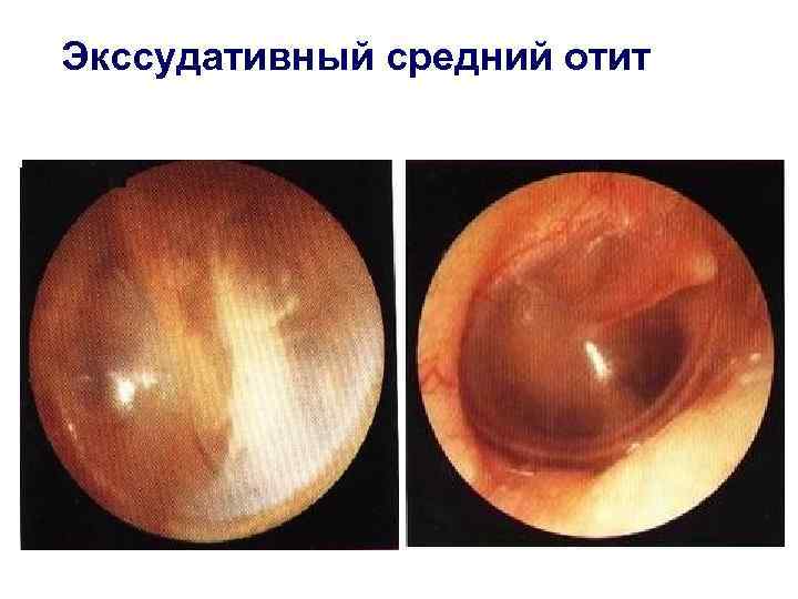 Экссудативный средний отит 