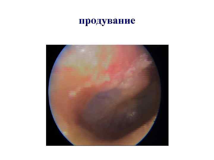 продувание 