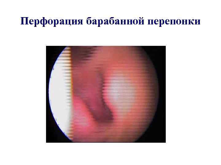 Перфорация барабанной перепонки 