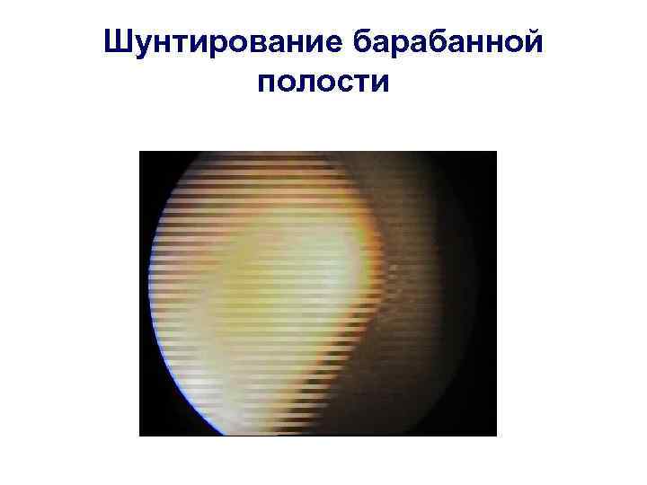 Шунтирование барабанной  полости 