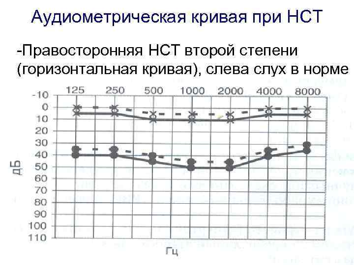  Аудиометрическая кривая при НСТ -Правосторонняя НСТ второй степени (горизонтальная кривая), слева слух в