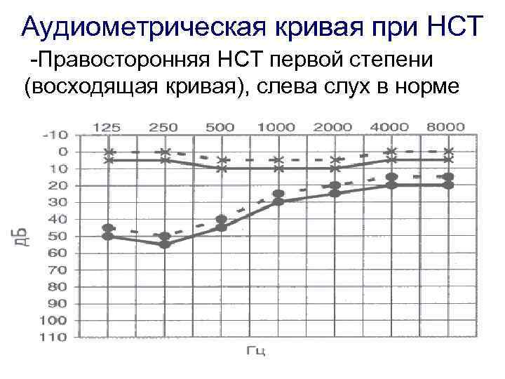 Аудиометрическая кривая при НСТ -Правосторонняя НСТ первой степени (восходящая кривая), слева слух в норме