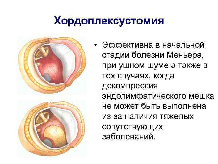 Хордоплексустомия   • Эффективна в начальной   стадии болезни Меньера,  