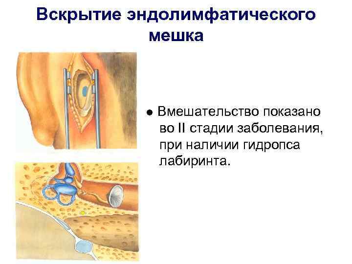 Вскрытие эндолимфатического  мешка   Вмешательство показано    во II стадии
