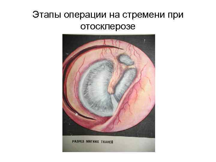 Этапы операции на стремени при   отосклерозе 