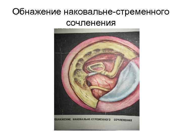 Обнажение наковальне-стременного  сочленения 