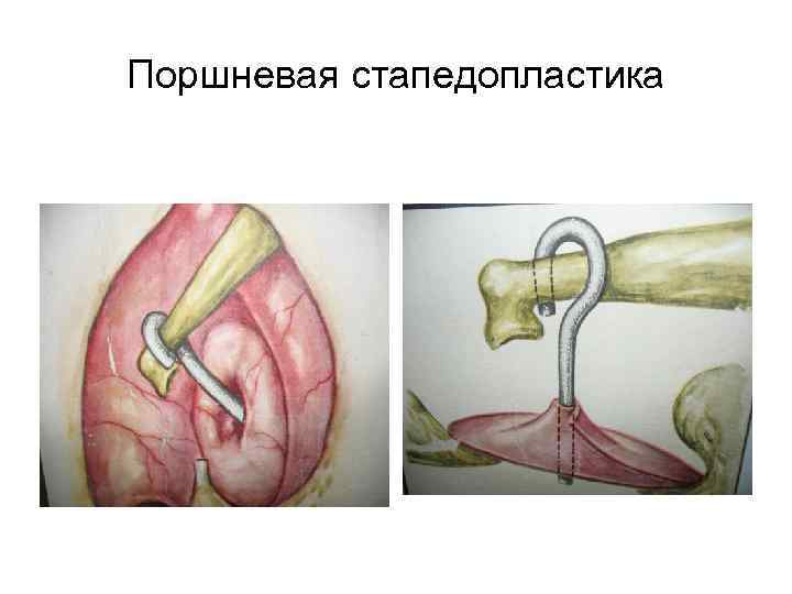 Поршневая стапедопластика 