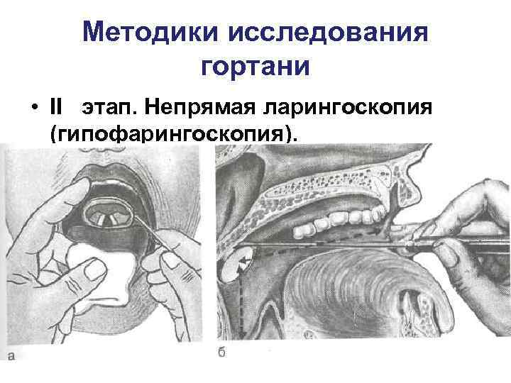   Методики исследования  гортани • II этап. Непрямая ларингоскопия  (гипофарингоскопия). 