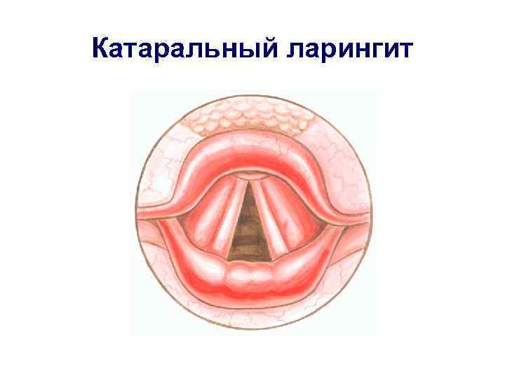 Катаральный ларингит 
