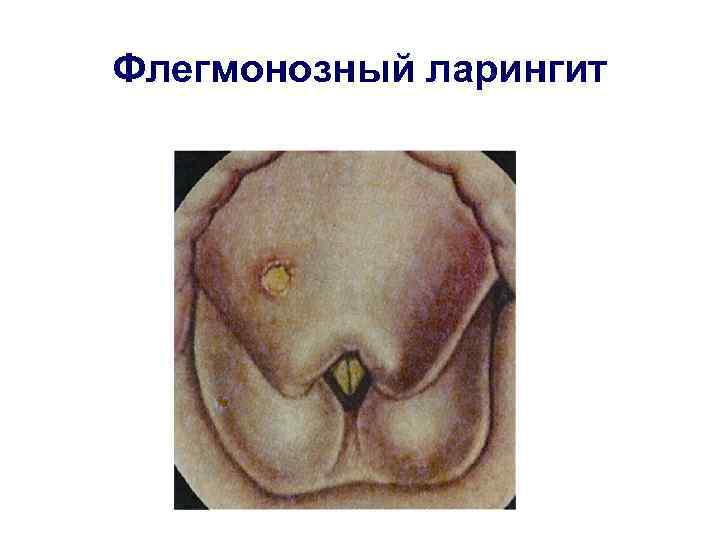 Флегмонозный ларингит 