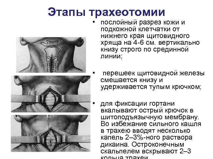 Этапы трахеотомии  • послойный разрез кожи и   подкожной клетчатки от 