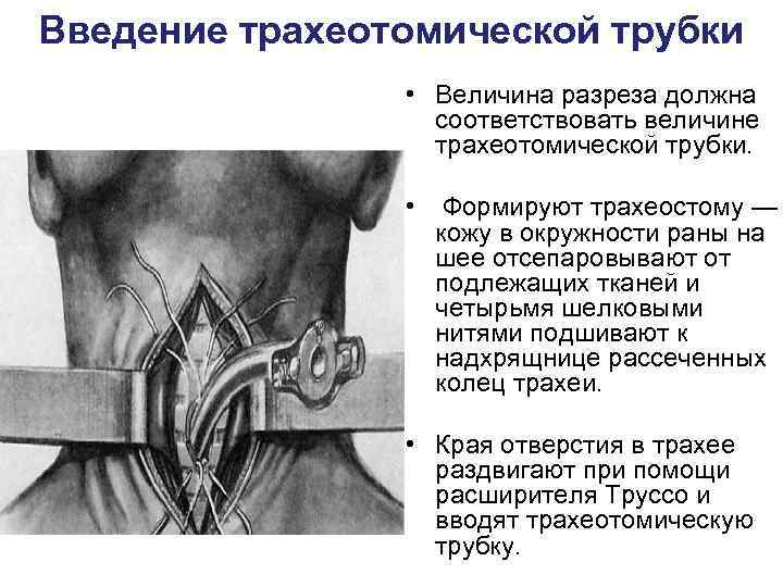 Введение трахеотомической трубки   • Величина разреза должна    соответствовать величине