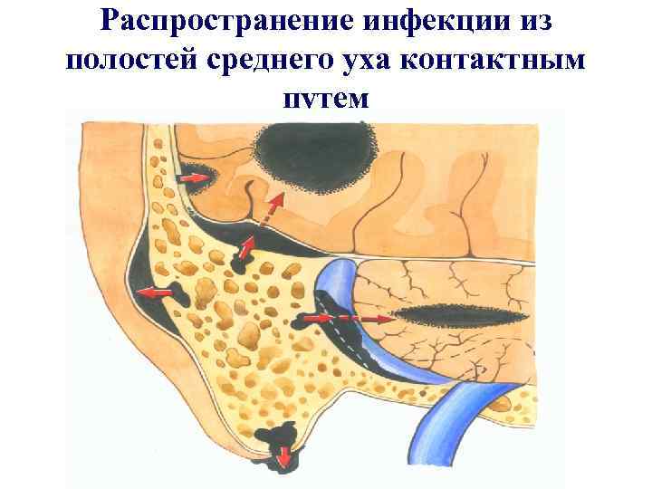 > Распространение инфекции из полостей среднего уха контактным    путем 