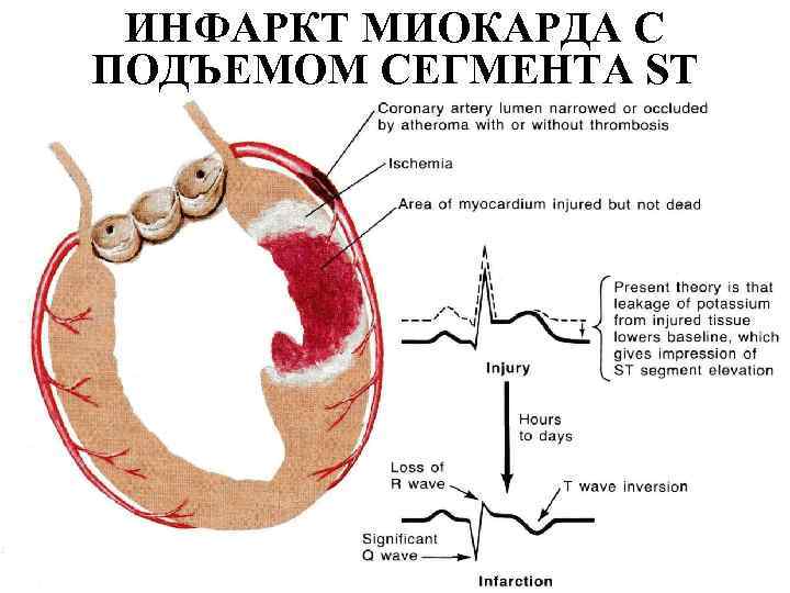 ИНФАРКТ МИОКАРДА С ПОДЪЕМОМ СЕГМЕНТА ST ИНФАРКТ МИОКАРДА С ПОДЪЕМОМ СЕГМЕНТА ST