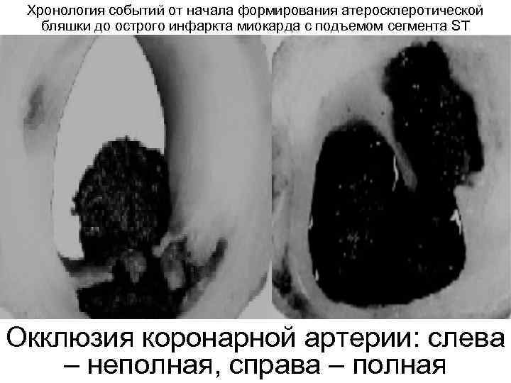 Хронология событий от начала формирования атеросклеротической бляшки до острого инфаркта миокарда с подъемом Хронология событий от начала формирования атеросклеротической бляшки до острого инфаркта миокарда с подъемом