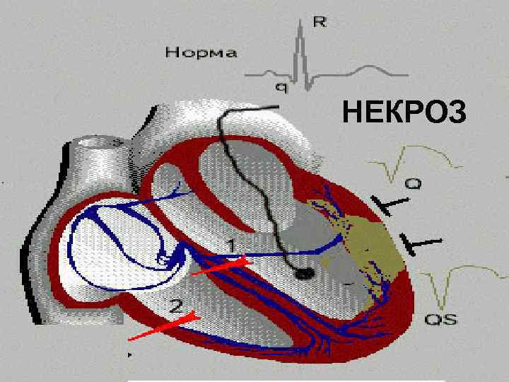 НЕКРОЗ НЕКРОЗ