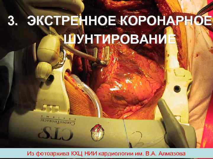 3. ЭКСТРЕННОЕ КОРОНАРНОЕ ШУНТИРОВАНИЕ Из фотоархива КХЦ НИИ кардиологии им. В. 3. ЭКСТРЕННОЕ КОРОНАРНОЕ ШУНТИРОВАНИЕ Из фотоархива КХЦ НИИ кардиологии им. В.
