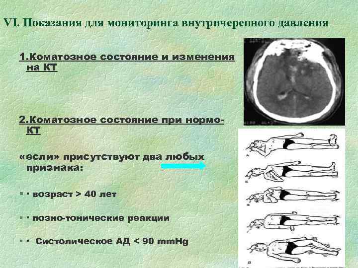 VI. Показания для мониторинга внутричерепного давления 1. Коматозное состояние и изменения на VI. Показания для мониторинга внутричерепного давления 1. Коматозное состояние и изменения на