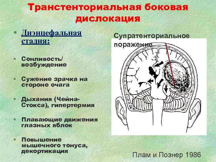 Транстенториальная боковая дислокация § Диэнцефальная Супратенториальное стадия: Транстенториальная боковая дислокация § Диэнцефальная Супратенториальное стадия: