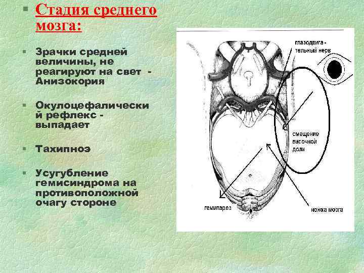 § Стадия среднего мозга: § Зрачки средней величины, не реагируют на § Стадия среднего мозга: § Зрачки средней величины, не реагируют на
