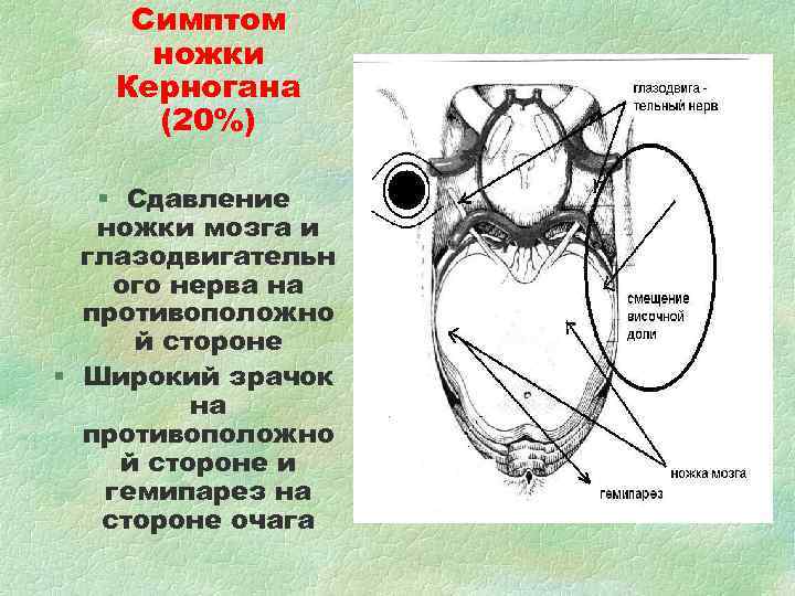 Симптом ножки Керногана (20%) § Сдавление ножки мозга и Симптом ножки Керногана (20%) § Сдавление ножки мозга и