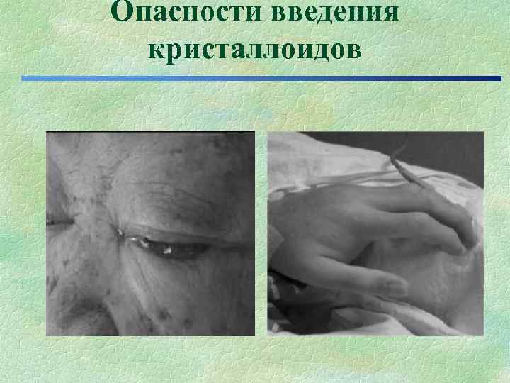 Опасности введения кристаллоидов Опасности введения кристаллоидов