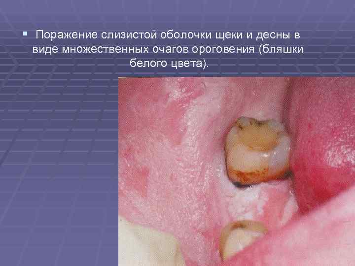 § Поражение слизистой оболочки щеки и десны в виде множественных очагов ороговения (бляшки § Поражение слизистой оболочки щеки и десны в виде множественных очагов ороговения (бляшки