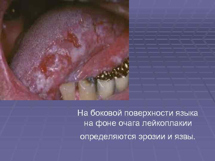 На боковой поверхности языка на фоне очага лейкоплакии определяются эрозии и язвы. На боковой поверхности языка на фоне очага лейкоплакии определяются эрозии и язвы.