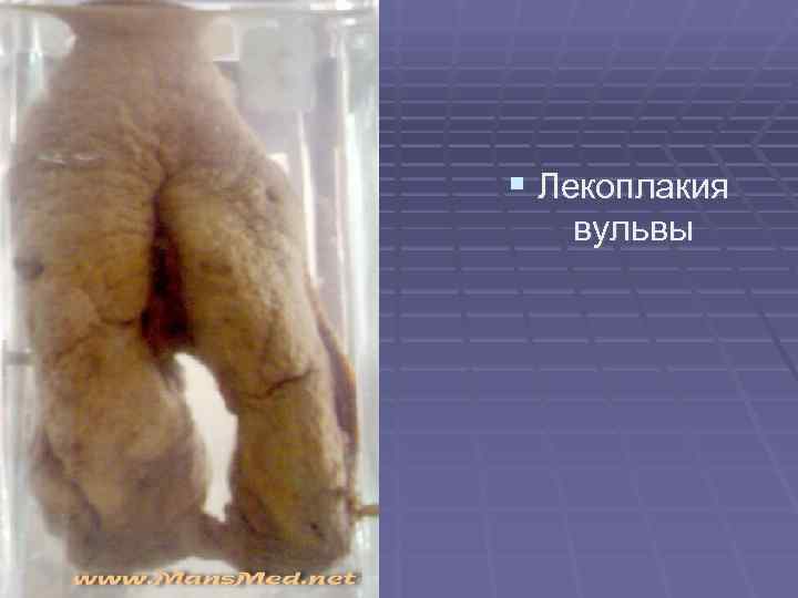 § Лекоплакия вульвы § Лекоплакия вульвы