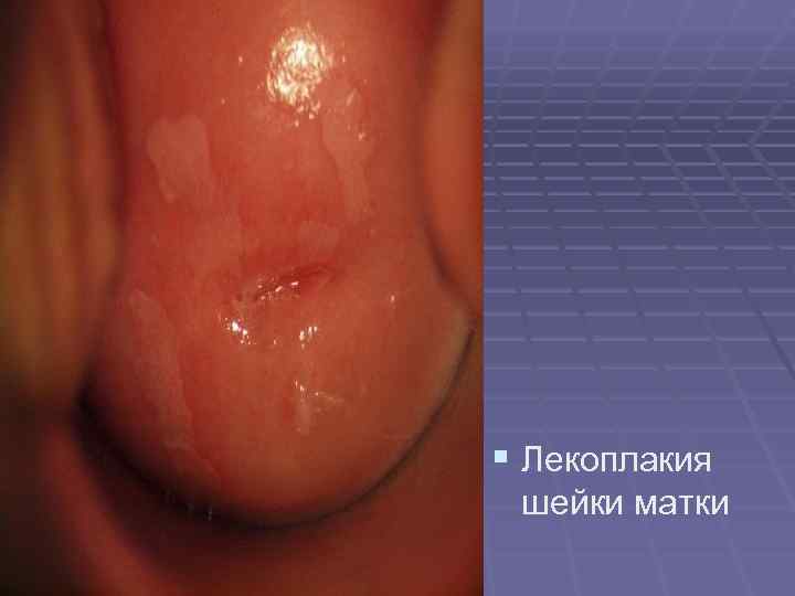 § Лекоплакия шейки матки § Лекоплакия шейки матки