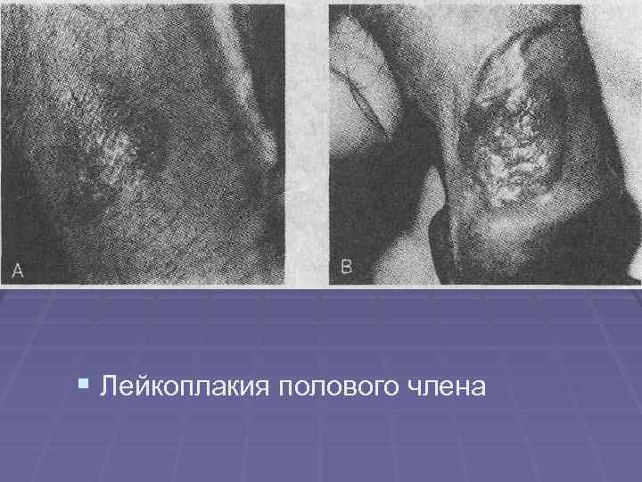 § Лейкоплакия полового члена § Лейкоплакия полового члена