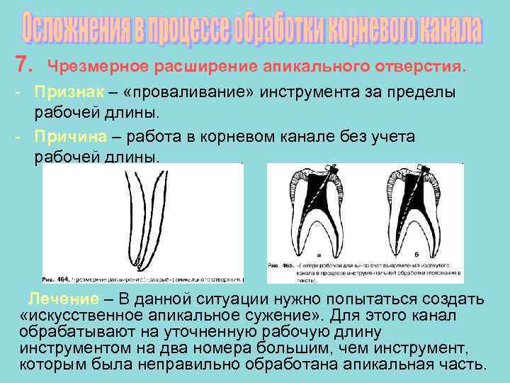 Ошибки и осложнения при лечении периодонтита