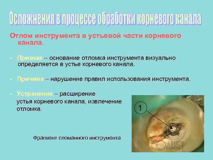 Отлом инструмента в устьевой части корневого  канала.  - Признак – основание отломка