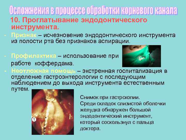  10. Проглатывание эндодонтического инструмента. - Признак – исчезновение эндодонтического инструмента  из полости